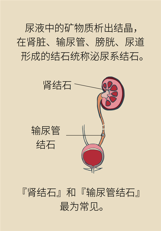 結(jié)石科普：身體里多了各種結(jié)石，應(yīng)該怎么辦？