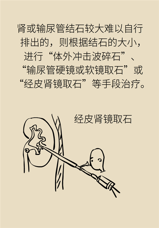結(jié)石科普：身體里多了各種結(jié)石，應(yīng)該怎么辦？