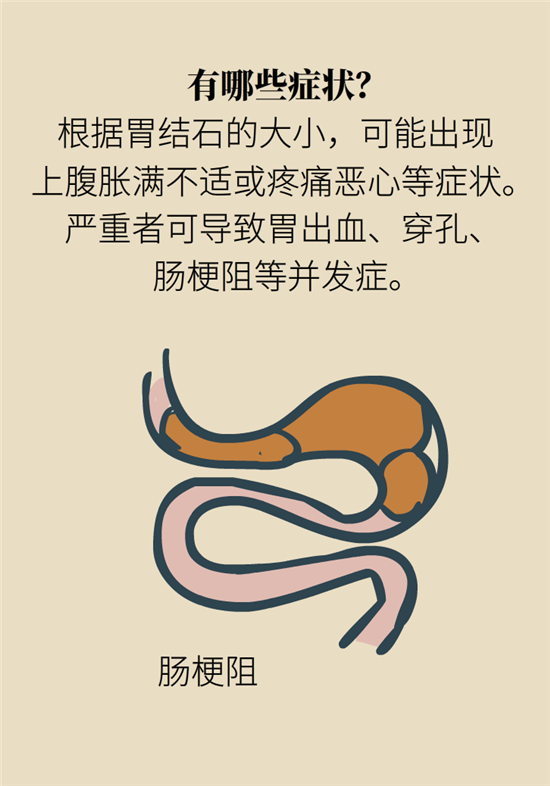 結(jié)石科普：身體里多了各種結(jié)石，應(yīng)該怎么辦？