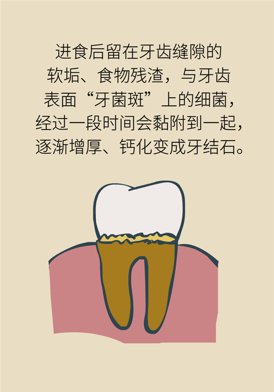 結(jié)石科普：身體里多了各種結(jié)石，應(yīng)該怎么辦？
